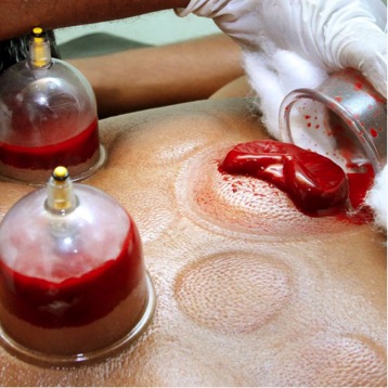 Hijama Cupping